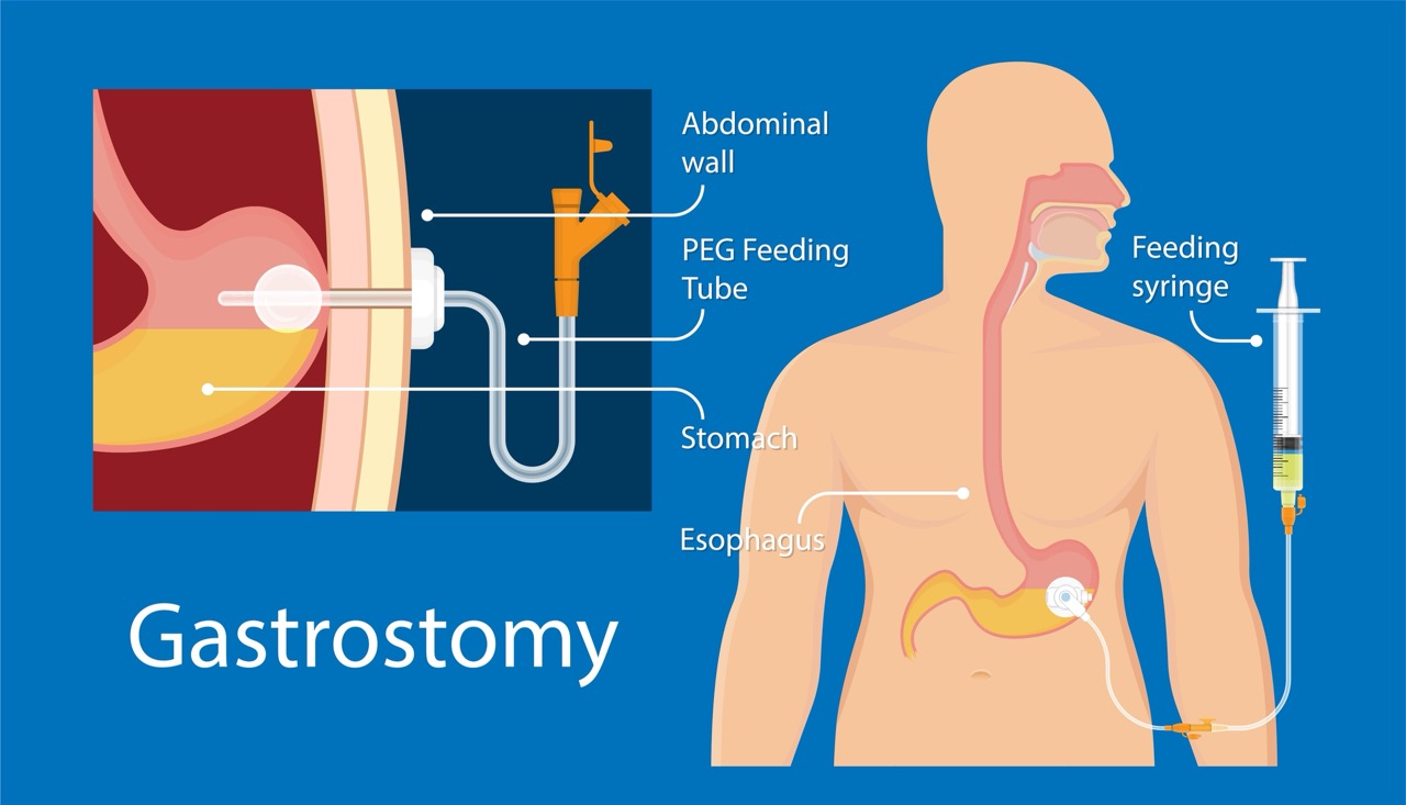 Gastrostomy Tube (G-Tube) Management | Park Shore Pharmacon